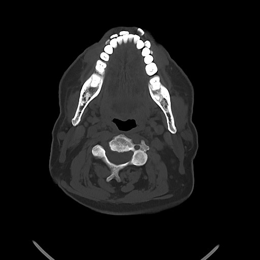 Chronic osteomyelitis - calvarial (severe) (Radiopaedia 69668-79616 Axial bone window 9).jpg