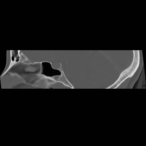 File:Chronic otomastoiditis (Radiopaedia 27138-27309 Sagittal bone window 31).jpg