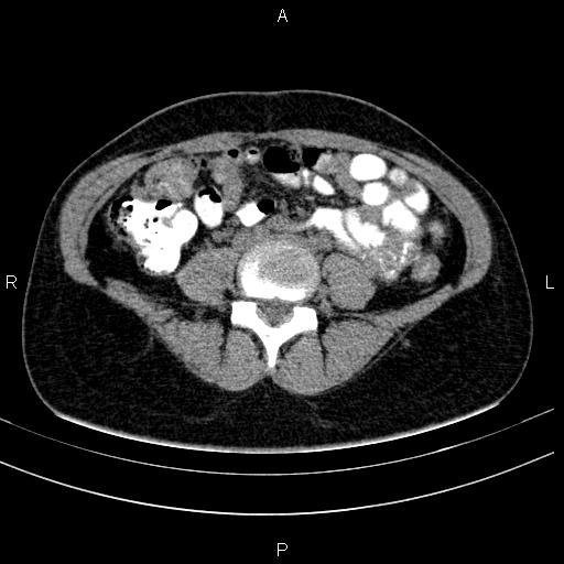 Chronic pancreatitis (Radiopaedia 64576-73450 Axial non-contrast 102).jpg