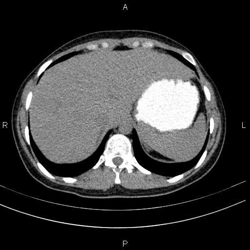 File:Chronic pancreatitis (Radiopaedia 64576-73450 Axial non-contrast 18).jpg