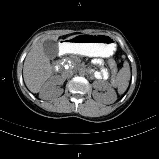 File:Chronic pancreatitis (Radiopaedia 64576-73450 Axial non-contrast 54).jpg