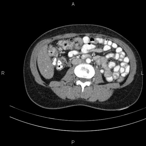 Chronic pancreatitis (Radiopaedia 64576-73450 B 86).jpg