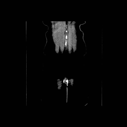 Chronic portal venous thrombosis with cavernous transformation (Radiopaedia 73618-84398 B 95).jpg