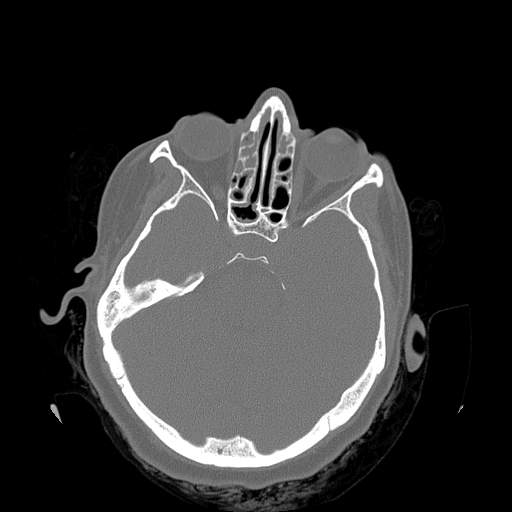 File:Chronic sinusitis with intra-sinus calcification (Radiopaedia 63919-72668 Axial bone window 16).jpg