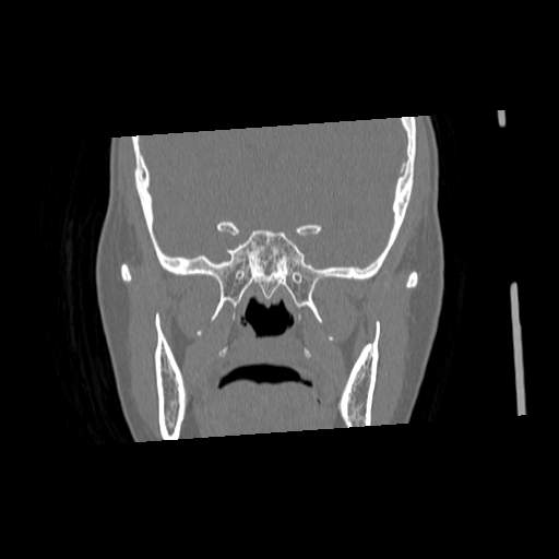 File:Chronic sinusitis with intra-sinus calcification (Radiopaedia 63919-72668 Coronal bone window 20).jpg