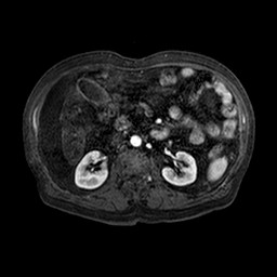 Cirrhosis and hepatocellular carcinoma in the setting of hemochromatosis (Radiopaedia 75394-86594 Axial T1 C+ fat sat 106).jpg