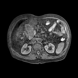 Cirrhosis and hepatocellular carcinoma in the setting of hemochromatosis (Radiopaedia 75394-86594 Axial T1 C+ fat sat 27).jpg