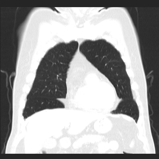 File:Classic complicated silicosis (Radiopaedia 49720-54961 Coronal lung window 15).jpg
