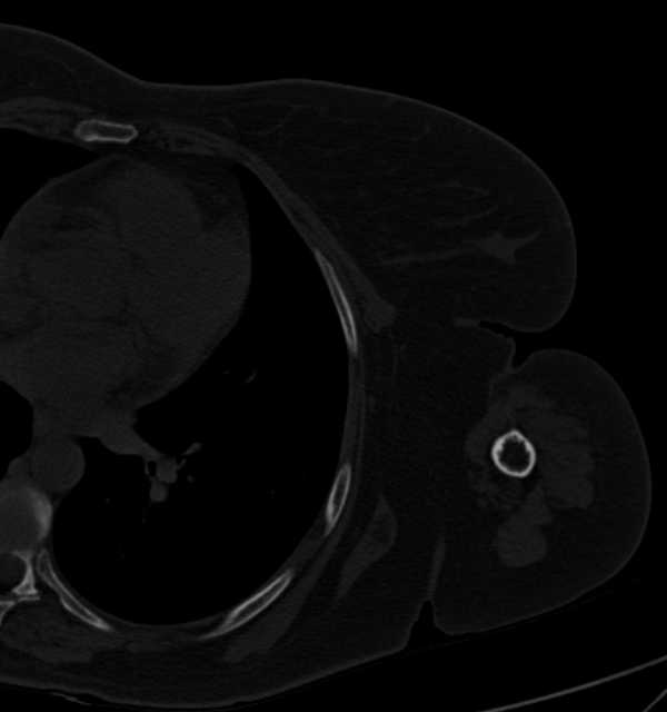 Clear cell chondrosarcoma - humerus (Radiopaedia 63104-71612 Axial bone window 96).jpg