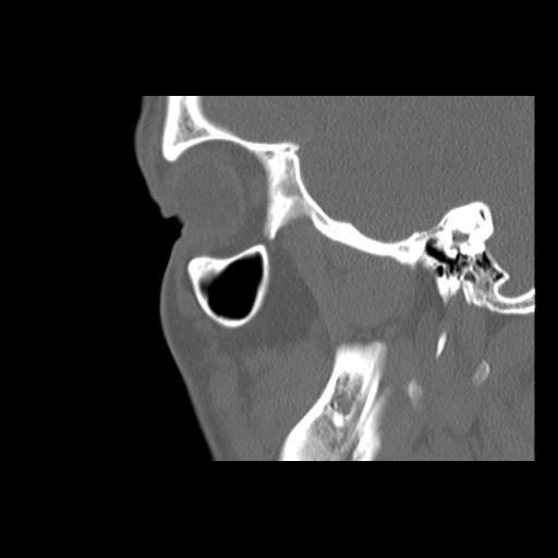 Cleft hard palate and alveolus (Radiopaedia 63180-71710 Sagittal bone window 38).jpg