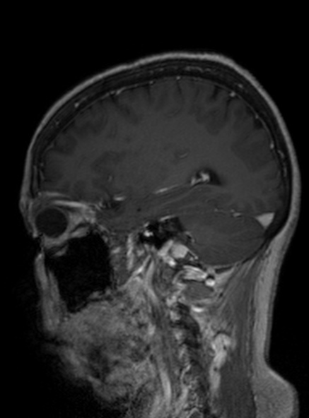Clival meningioma (Radiopaedia 53278-59248 Sagittal T1 C+ 204).jpg