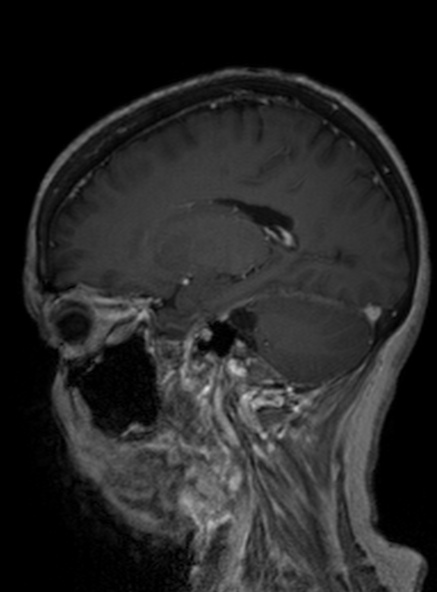Clival meningioma (Radiopaedia 53278-59248 Sagittal T1 C+ 296).jpg