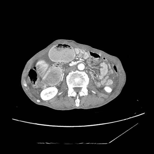 Closed-loop obstruction due to peritoneal seeding mimicking internal hernia after total gastrectomy (Radiopaedia 81897-95864 A 88).jpg