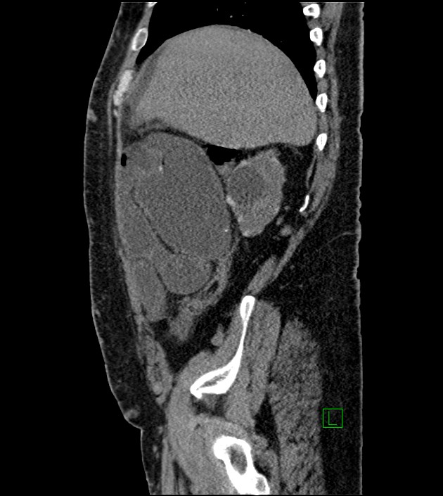 Closed-loop small bowel obstruction-internal hernia (Radiopaedia 78439-91096 C 111).jpg