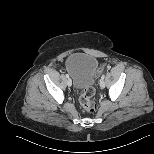 File:Closed loop obstruction - internal hernia into nephrectomy bed (Radiopaedia 59867-67320 A 123).jpg