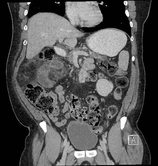 File:Closed loop obstruction - internal hernia into nephrectomy bed (Radiopaedia 59867-67320 B 60).jpg