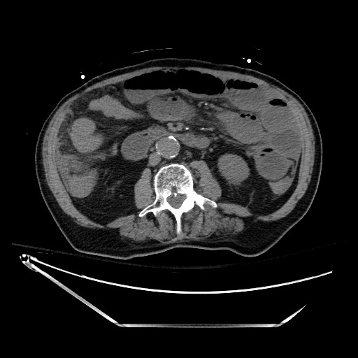 File:Closed loop obstruction due to adhesive band, resulting in small bowel ischemia and resection (Radiopaedia 83835-99023 Axial 51).jpg