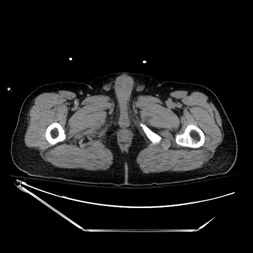File:Closed loop obstruction due to adhesive band, resulting in small bowel ischemia and resection (Radiopaedia 83835-99023 Axial non-contrast 174).jpg
