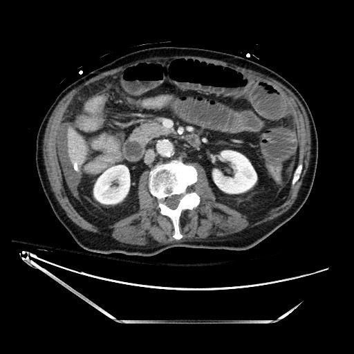 Closed loop obstruction due to adhesive band, resulting in small bowel ischemia and resection (Radiopaedia 83835-99023 D 68).jpg