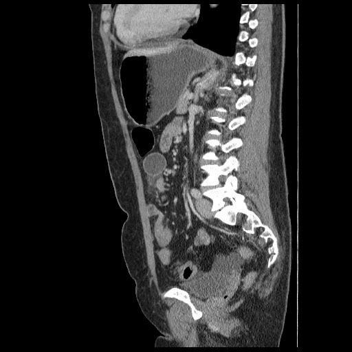 Closed loop small bowel obstruction (Radiopaedia 65403-74451 C 62).jpg