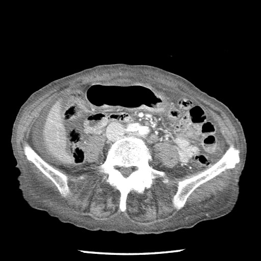 Closed loop small bowel obstruction - adhesions and infarct (Radiopaedia 85125-100678 B 56).jpg