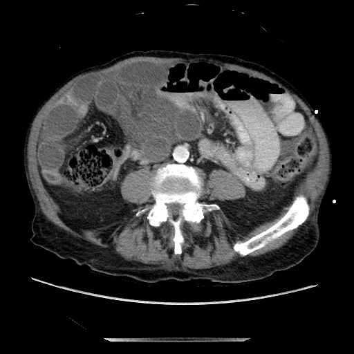 File:Closed loop small bowel obstruction - adhesive disease and hemorrhagic ischemia (Radiopaedia 86831-102990 A 115).jpg