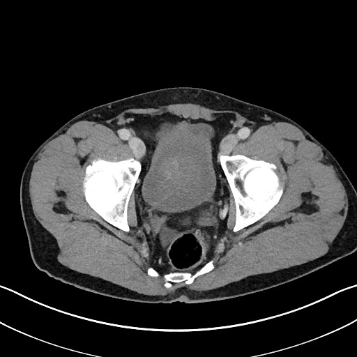 File:Closed loop small bowel obstruction - internal hernia (Radiopaedia 57806-64778 B 116).jpg