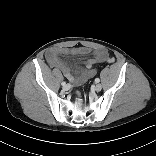 File:Closed loop small bowel obstruction - internal hernia (Radiopaedia 57806-64778 B 99).jpg