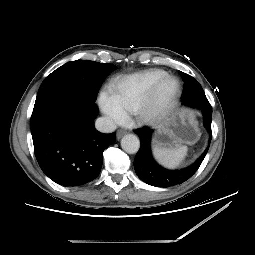 Closed loop small bowel obstruction - omental adhesion causing "internal hernia" (Radiopaedia 85129-100682 A 10).jpg