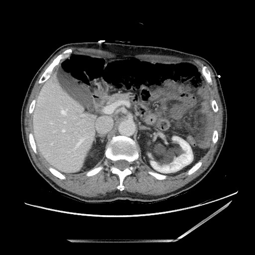 Closed loop small bowel obstruction - omental adhesion causing "internal hernia" (Radiopaedia 85129-100682 A 46).jpg