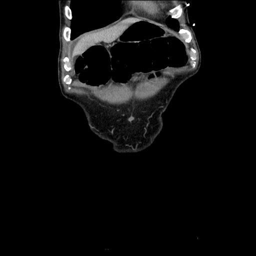 File:Closed loop small bowel obstruction - omental adhesion causing "internal hernia" (Radiopaedia 85129-100682 B 25).jpg