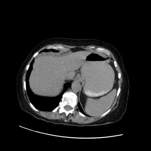Closed loop small bowel obstruction due to adhesive band, with intramural hemorrhage and ischemia (Radiopaedia 83831-99017 Axial non-contrast 36).jpg