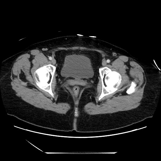 Closed loop small bowel obstruction due to adhesive bands - early and late images (Radiopaedia 83830-99014 A 146).jpg