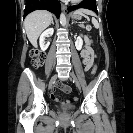 Closed loop small bowel obstruction due to adhesive bands - early and late images (Radiopaedia 83830-99014 B 74).jpg