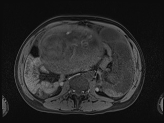 Closed loop small bowel obstruction in pregnancy (MRI) (Radiopaedia 87637-104031 Axial T1 fat sat 67).jpg