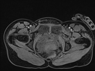 File:Closed loop small bowel obstruction in pregnancy (MRI) (Radiopaedia 87637-104031 G 25).jpg