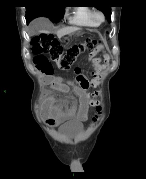Closed loop small bowel obstruction with ischemia (Radiopaedia 84180-99456 B 55).jpg