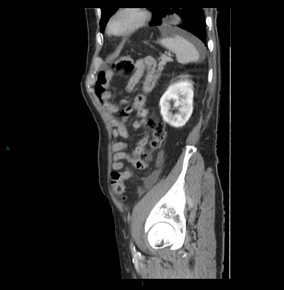 Closed loop small bowel obstruction with ischemia (Radiopaedia 84180-99456 C 72).jpg