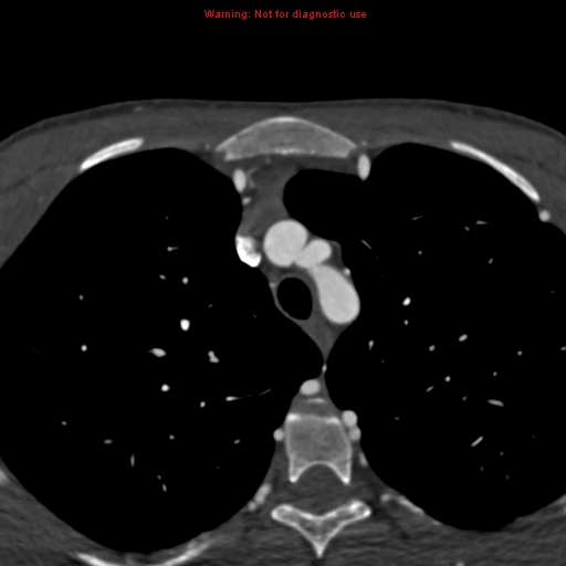 File:Coarctation of the aorta (Radiopaedia 12461-12697 A 29).jpg