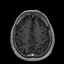 File:Cochlear incomplete partition type III associated with hypothalamic hamartoma (Radiopaedia 88756-105498 Axial T1 C+ 146).jpg