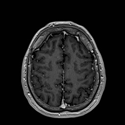 Cochlear incomplete partition type III associated with hypothalamic hamartoma (Radiopaedia 88756-105498 Axial T1 C+ 151).jpg