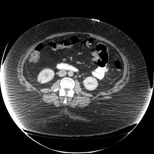 Collection due to leak after sleeve gastrectomy (Radiopaedia 55504-61972 A 42).jpg