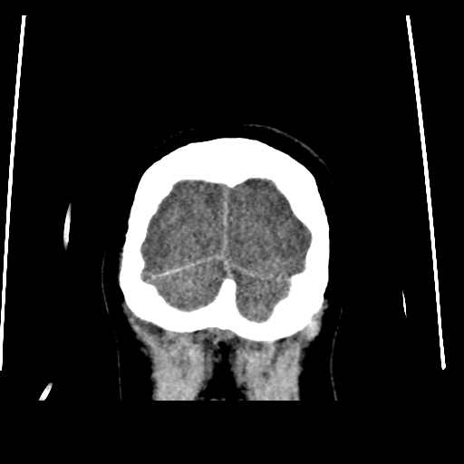 Colloid cyst (resulting in death) (Radiopaedia 33423-34469 Coronal non-contrast 51).png