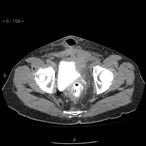File:Colo-cutaneous fistula (Radiopaedia 40531-43129 A 83).jpg