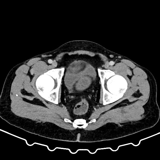 Colocolic intussusception due to large lipoma (Radiopaedia 68773-78482 A 179).jpg