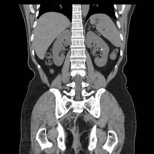 File:Colocutaneous fistula in Crohn's disease (Radiopaedia 29586-30093 Coronal non-contrast 30).jpg