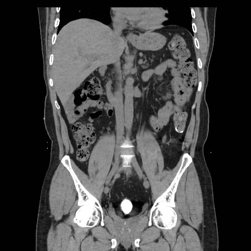 File:Colocutaneous fistula in Crohn's disease (Radiopaedia 29586-30093 E 20).jpg