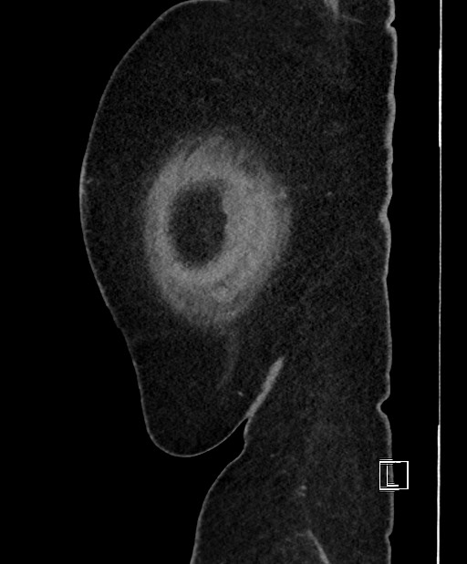 Colon adenocarcinoma (Radiopaedia 59374-66735 C 7).jpg