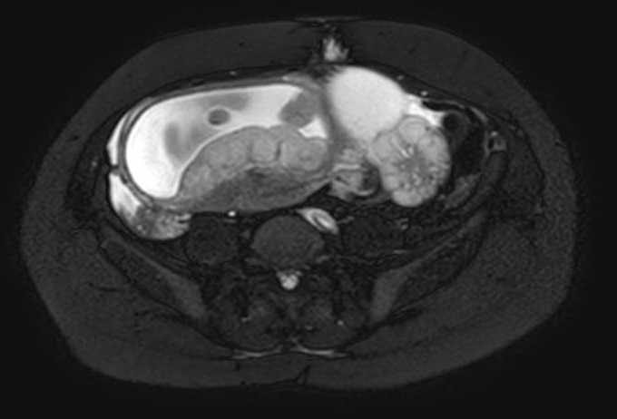 Colon adenocarcinoma with Krukenberg tumors, advanced pregnancy (Radiopaedia 67279-76645 Axial T2 SPAIR 29).jpg