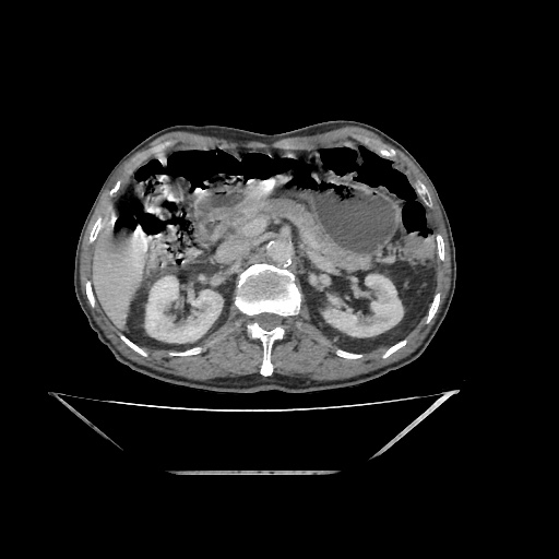 Colon cancer (ultrasound) (Radiopaedia 77249-89300 A 53).jpg